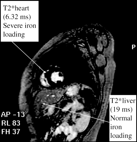 FIGURE 1 Magnetic resonance imaging scan of a thalassemia patient indicating normal range T2* of iron deposition in the liver and of severe iron loading deposition in the heart. The figure was adapted from Figure 3 in (Citation[19]); with permission.