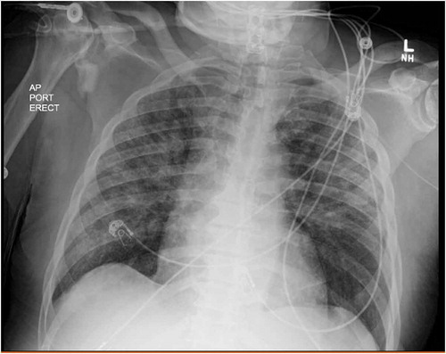 Figure 4. Erect anteroposterior (AP) chest x-ray taken with a portable (port) x-ray machine one day after daptomycin was discontinued showing decreased bilateral alveolar infiltrates compared to Figure 1. L = left side