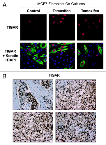 Figure 5. Tamoxifen induces TIGAR upregulation in cocultured MCF7 cells. (A) Fibroblast-MCF7 cell cocultures were cultured for 1 d with 12 µM tamoxifen or with vehicle alone. Then, cells were fixed and immuno-stained with anti-TIGAR (red) and anti K8–18 (green) antibodies. Nuclei were counterstained with DAPI (blue). TIGAR staining (red only) is shown in the top panels to better appreciate the tamoxifen-induced TIGAR upregulation in MCF7 cells. Original magnification 40x. (B) TIGAR is highly expressed in human epithelial breast cancer samples with loss of stromal Cav-1. Paraffin-embedded tissue sections from human breast cancer samples lacking Cav-1 were immunostained with antibodies directed against TIGAR. Slides were counterstained with hematoxylin. Note that TIGAR is highly expressed preferentially in epithelial breast cancer cells while stromal cells lack TIGAR expression. Original magnification, 40x.