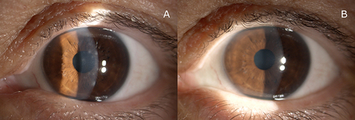 Figure 1 (A) Pre-operative clinical slit lamp image showing the left eye of a 38 year-old female patient (I.C.) with persistent corneal infiltrates following adenovirus infection and irregular astigmatism. The UDVA was 20/200, the CDVA was 20/63 with a refraction of +1.25 sph = −5 cyl ax180°. The patient complained permanent glare, photophobia and decreased visual acuity. (B) 12-months following PRK the slit-lamp image evidenced a resolution of corneal infiltrates and a clear cornea. The final postoperative UDVA was 20/20.