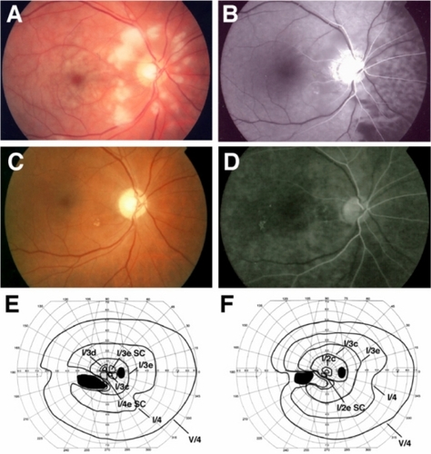 Figure 1 Clinical findings for Case 1. Fundus photographs and fluorescent angiograms before treatment. There are many cotton wool patches surrounding the optic disc and retinal whitening surrounding the fovea (A). Fluorescein angiography shows nonperfused areas of retinal arterioles in the areas corresponding to the areas of cotton wool patches. A delay in the choroidal filling in the nasal area and arm-to-retina time (32 seconds) was found (B). Fundus photograph (C) and fluorescent angiogram (D) after treatment. Optic disc is slightly pale, and defects of the nerve fiber layer can be seen (C). Fluorescein angiography shows improvement of the retinal circulation (D). Arm-to-retina time was 15 seconds. Goldmann kinetic perimetry before (E) and after (F) treatment. There is a large absolute scotoma in the lower nasal field and paracentral scotoma before treatment (E). The paracentral scotoma is decreased after treatment (F).