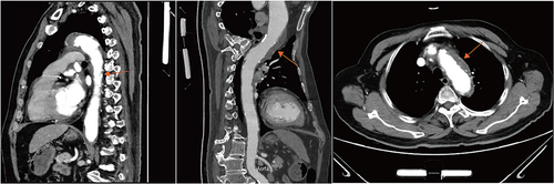 Figure 2 Chest CTA showing: multiple atherosclerosis and ulcers, and intermural hematoma formation in the aortic arch and thoracic aorta. Combined with the patient’s diagnosis of miliary tuberculosis, the involvement of tuberculosis in the aorta should be highly suspected.