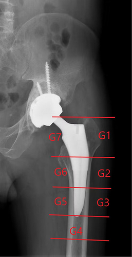 Figure 1 Dual-energy X-ray absorptiometry images with Gruen zone schemes.