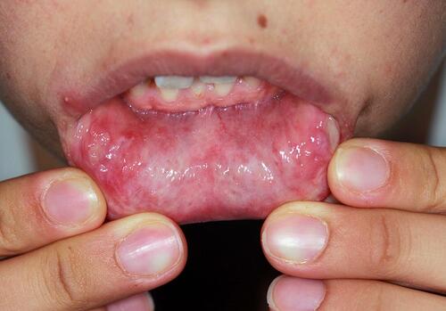 Figure 1 Oral ulcers on the lower lip mucosa.