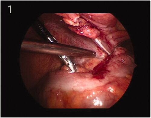 Figure 1. The PD catheter (Tenckhoff catheter) was wrapped by the sigmoid mesocolon.