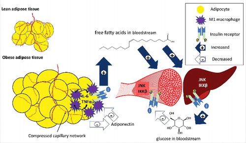 Figure 1. An overview of inflammation and ischemia in obese adipose tissue. Excess fat storage in obese individuals leads to adipose tissue expansion as compared to lean individuals, and the blood supply does not adequately match this tissue expansion. This adipocyte hypertrophy and inadequate blood supply causes adipocyte hypoxia, inflammatory cytokine release (IL-6, TNFα) by adipocytes and M1 macrophages, a reduction in adiponectin release, and impaired insulin action. Low adiponectin promotes the pro-inflammatory profile of macrophages, and adipocytes and macrophages act in a paracrine fashion to further increase cytokine release from neighboring adipose tissue. Insulin resistance in adipocytes causes impaired suppression of lipolysis, and fatty acids are released and deposited in other insulin target tissues such as skeletal muscle and liver. Partially oxidized fatty acids increase inflammation through proteins such as JNK and IKKβ in the liver and skeletal muscle, impairing insulin signaling in these tissues. Impaired insulin action in the liver leads to an increase in glucose release (impaired suppression of glycolysis), and in skeletal muscle leads to decreased glucose uptake (impaired GLUT-4 translocation). The end result is hyperglycemia, hyperlipidemia, meta-inflammation, and insulin resistance. Filled arrows with + signs represent increases in release or uptake, while unfilled arrows with – signs represent decreases in release or uptake.