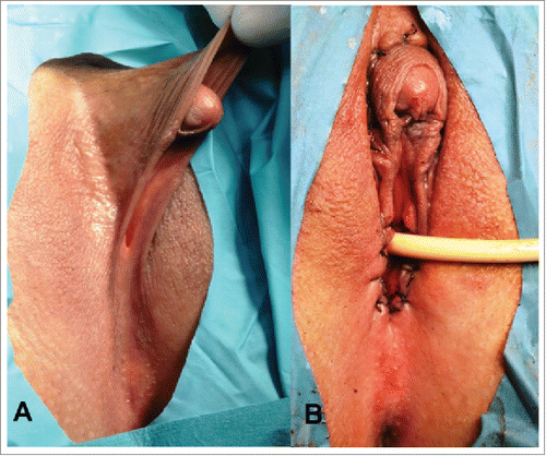 FIGURE 1. Congenital adrenal hyperplasia. Prader stage III. (A) External genitalia before operation. Clitoromegaly and sinus urogenitalis resulted of incomplete posterior labial fusion. (B) External genitalia after clitororeduction and introitoplasty.