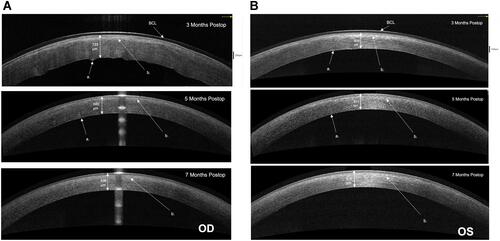 Figure 2 (A) AS-OCT OD progression over time. Corneal thicknesses are indicated. Descemet membrane folds (a) and anterior stromal edema (b) are indicated. (B) AS-OCT OS progression over time. Corneal thicknesses are indicated. Descemet membrane folds (a) and anterior stromal edema (b) are indicated.