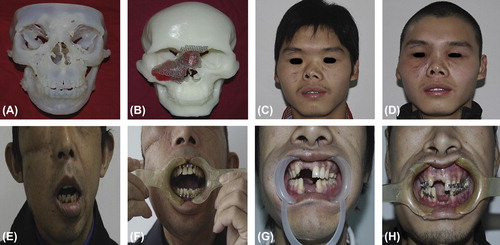 Figure 10. Preoperative planning for patients with craniomaxillofacial post-traumatic deformity. (A) Resinous craniofacial model manufactured using a rapid prototyping device. (B) Preshaping of titanium mesh or plates on rapid prototyping models. (C) Preoperative view of the patient. (D) Postoperative view of the patient. (E) Preoperative mouth opening of the patient. (F) Postoperative mouth opening of the patient. (G) Preoperative occlusion. (H) Postoperative occlusion. Adapted from reference (Citation162) with permission of Journal of Oral and Maxillofacial Surgery, Elsevier, Copyright 2014.