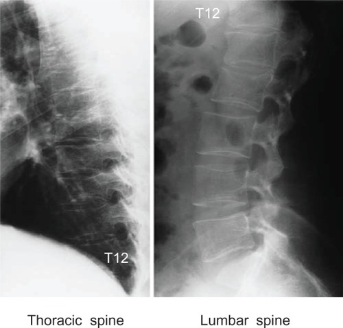 Figure 1 Radiographs of thoracic and lumbar spine.