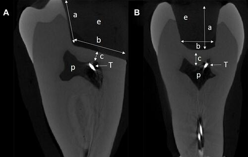 Figure 2 Micro-CT. Cross-section of the tooth. (A) Mesial-distal view: p-pulp chamber, T-tip of the thermocouple, e-empty cavity, a=4 mm, b=8 mm. (B) Bucco-lingual view: p-pulp chamber, T-tip of the thermocouple, e-empty cavity, a= 4 mm, c=1 mm.