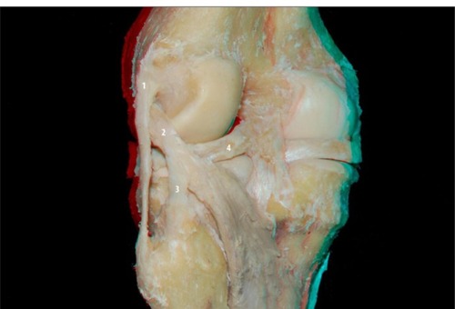 Figure 2 Posterior view of the knee: lateral collateral ligament (1), popliteus tendon (2), popliteofibular ligament (3), and lateral meniscus (4).