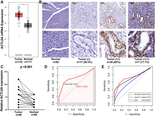 Figure 1 Expression of ACTL6A in PC and normal tissues. (A) Differential expression of Actl6a mRNA between pancreatic tumor and normal tissues. (B) Immunohistochemical results of typical normal tissues and PC tissues with different staining intensities. (C) Differential expression of ACTL6A between pancreatic tumor and normal tissues. (D) ACTL6A represented a moderate diagnostic value. The ROC of pancreatic cancer samples and normal tissues. (E) ROC for the diagnostic efficiency of ACTL6A, serum CEA, and serum CA19–9. *p<0.05.