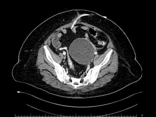 Figure 1 CT scan of the pelvis findings.