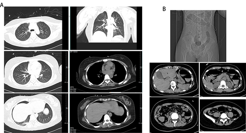 Figure 4 The lung and abdominal computerized tomography. (A) Lung computerized tomography showed scattered streaks in the right lower lung April 21th. (B) Full abdominal computerized tomography scan revealed that colorectal dilatation, which need being ware of paralytic intestinal obstruction April 24th.