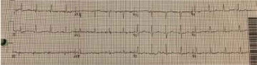 Figure 5. EKG showing resolution of ST segment elevation.