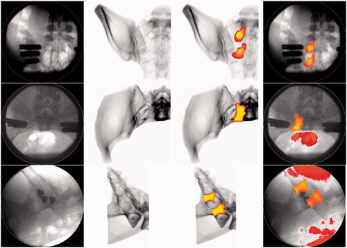 Figure 3. Overview showing the perioperative fluoroscopy images (first column) for the outlet (first row), inlet (second row) and lateral (third row) view. The corresponding DRR reconstruction is shown in the second column and the DRR including the superimposed S1 and s2 neural foramen segmentation can be seen in the third column. The fourth column shows the perioperative fluoroscopy with the superimposed, registered S1 and S2 neural foramen segmentation.