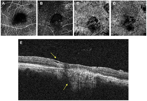 Figure 6 The OCTA image in the active lesion showed perfusion loss that marked with hypointense area. The lack of perfusion area related to the active lesion is shown in the superficial retinal layer (A) and more distinct in the deep retinal layer (B). It is also noted in the choroidal layer (C) and the choriocapillaris (D). The horizontal section of retinal layer (E) showed full thickness retinal thinning with choroidal shadowing and formation of epiretinal membrane (yellow arrow).
