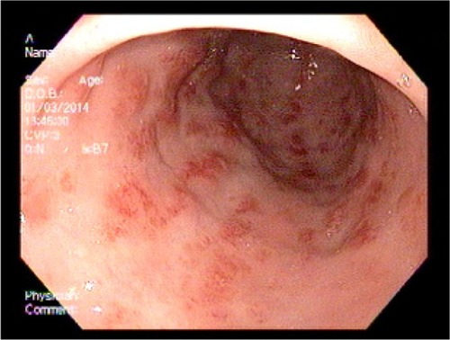 Figure 4 Upper endoscopy showing the typical longitudinal red stripes in the antrum radiating out from the pylorus, consistent with gastric antral vascular ectasia.