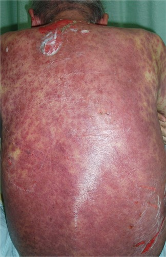 Figure 1 Fatal toxic epidermal necrolysis after cetuximab treatment for 8 weeks.Notes: A 74-year-old man who had moderately differentiated metastatic colon adenocarcinoma presented diffuse erythematous plaques with dusky red centers on trunk and extremities after treatment with cetuximab for 8 weeks. The skin rashes were confluent and formed large blisters or skin detachments involving more than 70% of the body surface area.