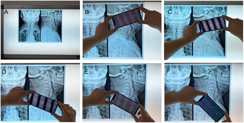 Figure 2. Measurement of the represented angles by smartphone’s intrinsic inclinometer. A. X-rays were placed on the film viewer, which was placed on the wall. B. Confirm the McGregor line, align a certain edge of the smartphone to the McGregor line, and record the angle displayed on the smartphone screen. C. Confirm the lower endplate of C2, align the same edge of the smartphone to the lower endplate of C2, and record the angle displayed on the smartphone screen. D. Confirm the lower endplate of C7, align the same edge of the smartphone to the lower endplate of C7, and record the angle displayed on the smartphone screen. E. Confirm the upper endplate of T1, align the same edge of the smartphone to the upper endplate of T1, and record the angle displayed on the smartphone screen. F. The line connecting the upper end of the sternum and the center of the T1 upper endplate aligned the same edge of the smartphone to this line and recorded the angle shown on the smartphone screen.