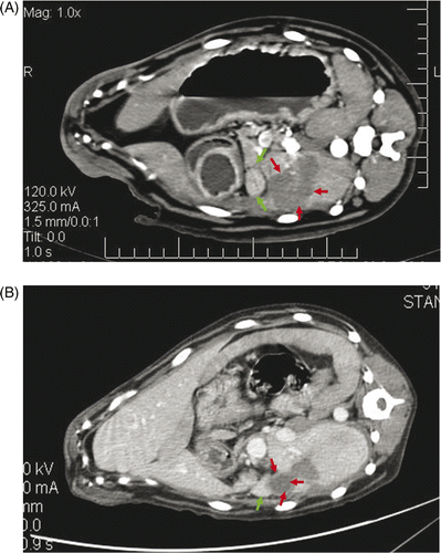 Figure 3. (A) Immediately after microwave ablation, contrast-enhanced CT showed the ablated lesions were located at the liver margin and were not enhanced (red arrow). The adjacent bowel walls were normal (green arrow). (B) Twenty-eight days after microwave ablation, the contrast-enhanced CT revealed there was no enhancement inside the lesion (red arrow) and the omentum covering the ablated liver was enhanced (green arrow).