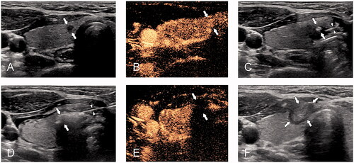 Figure 3. A 33-year-old woman with papillary thyroid cancer close to the capsule was treated with microwave ablation (MWA). (A) pre-MWA, ultrasound (US) showed a hypoechoic target tumor (arrows); (B) before MWA, contrast-enhanced US (CEUS) showed a hypo-enhancement pattern in the artery phase (arrows); (C) the hydrodissection technique (triangles) was used to protect the trachea surrounding the tumor (arrows); (D) US showed a hyperechoic pattern in the tumor (arrows) during ablation; (E) post-MWA, CEUS showed no enhancement (arrows) in the tumor area; and (F) on 1 month post-MWA, US showed a hypoechoic ablation zone (arrows).