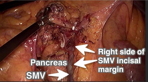 Figure 3 Right side of SMV incisal margin in laparoscopic CRR for right-sided colon cancer.Abbreviations: SMV, superior mesenteric vein; CRR, conventional radical resection.