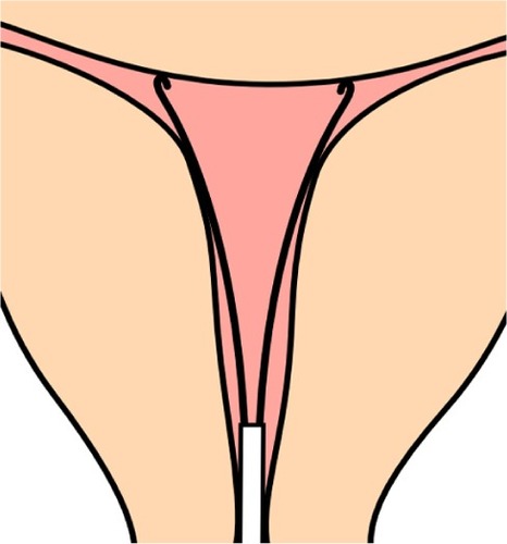 Figure 2 Illustration of how the fundal transverse diameter was measured with a specially designed instrument (cavimeter).