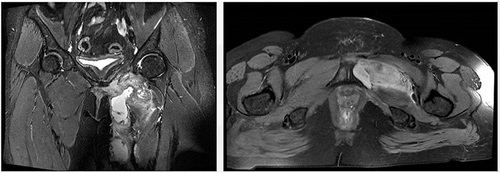 Figure 1 MRI presented lesions of the pubis and surrounding soft tissue.