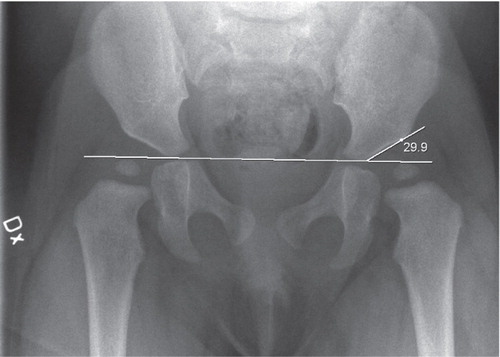 Figure 1. Example of an AI measurement at 1 year on the left side of a girl treated for bilateral neonatal dislocation (Barlow-positive).