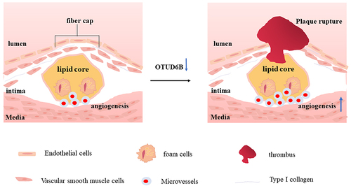 Figure 7 Summary of the roles of OTUD6B deficiency in diabetic plaque angiogenesis and plaque stability. The loss of OTUD6B may promotes angiogenesis in diabetic atherosclerosis and eventually lead to plaque rupture.