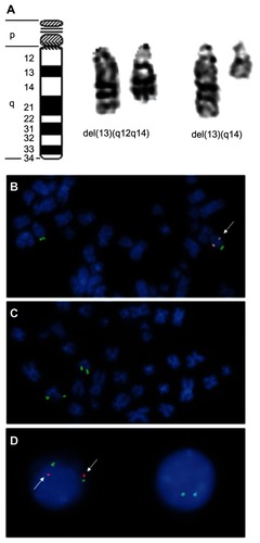 Figure 3 Deletions of chromosome 13 are the most frequent karyotype alterations in CLL. (A, left to right): Ideogram of chromosome 13, example of an interstitial deletion of the long arm of chromosome 13 in CLL, and example of a terminal deletion of chromosome 13 in CLL. (B) Part of a metaphase with monoallelic deletion of chromosome 13 as detected by FISH, the orange (spectrum: orange)-labeled probe detects the minimal deleted region, the green (spectrum: green)-labeled probe detects a terminal DNA segment of the long arm of chromosome 13 to facilitate its identification. Chromosomes are counterstained by DAPI. (C) Part of a metaphase with diallelic deletion of chromosome 13 as detected by FISH. For probes and counterstaining see (B). (D, left to right): nucleus of a normal cell without 13q-deletion and nucleus of a cell with biallelic deletion. For probes and counterstaining see (B).