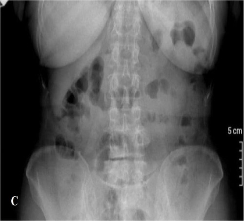 Figure 3 Preoperative AP view.