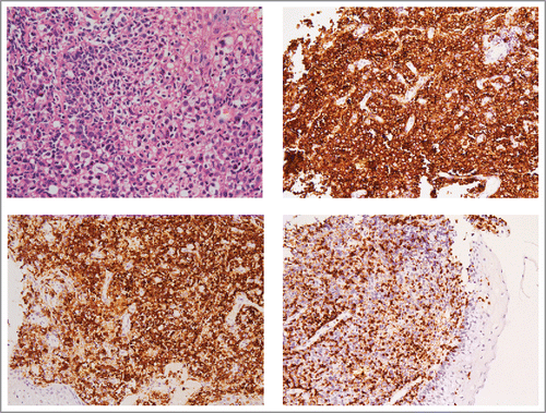 Figure 1. DLBCL in the root of tongue. (A) Histopathology of tongue showed diffuse infiltration of large B-cell lymphocytes (H&E,×400). (B) Immunohistochemical stain with anti-CD20 antibody (×200). (C) Anti-CD79α antibody (×200). (D) Anti-CD3 antibody (×200).