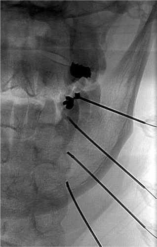 Figure 2 An anteroposterior radiograph of needle placement for third occipital nerve, C3-4, and C4-5 medial branch radiofrequency ablation.