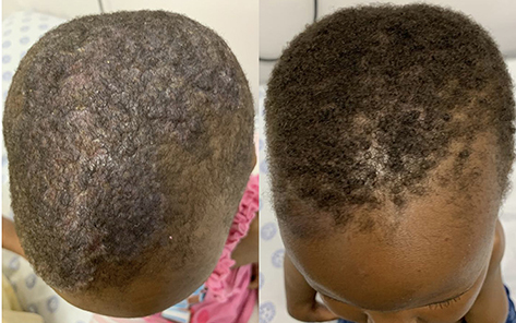 Figure 1 Lesions on scalp, before and after 8 weeks of azathioprine treatment.