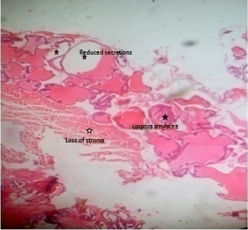 Figure 9. Photomicrograph of prostate tissue section of a rat from group 9 (BPH-induced and treated with 400 mg/kg of EAF) showing concretions especially corpora amylacea which appears as a hard compact mass usually ovoid in shape (black star) with loss of fibromuscular stroma (white star) and reduced convolutions usually papillary infoldings. At the same time there is reduced intraluminal secretions (red star) H&E. mag. 400X.