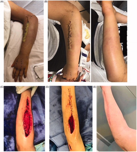 Figure 3. Appearance of forearm after (A) initial post-operative day two, with improvement in swelling and rash. (B) Readmission on post-operative day six with increased swelling. (C) Fourth operative irrigation and debridement. (D) Sixth and final irrigation and debridement with partial closure. (E) One year post-operatively.