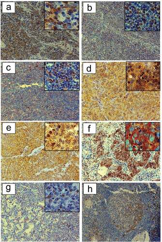 Figure 4. HSP90 expression in TETs. Immunohistochemical expression of HSP90 in WHO type A (a), AB (b), B1 (c), B2 (d), B3 (e), TC- Squamous Cell Carcinoma (f) and MNT (g) is shown (20X and 40X magnification). The representative sections (ac, eg) are from patients without MG, while section (d) is from a patient with paraneoplastic MG. Immunohistochemical staining of HSP90 in patients with non-thymomatous MG: a germinal center is depicted (H).