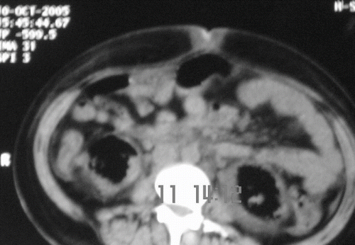Figure 2. Non-contrast computer tomographic scan of abdomen showing air echos in bilateral renal parenchymal and perinephric space, more marked on the left side.