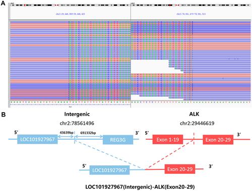 Figure 2 Next-generation sequencing findings of LOC101927967-ALK fusion. (A) The Integrative Genomics Viewer snapshot of LOC101927967-ALK. (B) Schematic representation of the LOC101927967 intergenic region ALK fusion, this variant was generated by the fusion of intergenic region between LOC101927967 and REG3G with exons 20–29 of ALK.