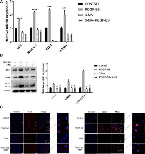 Figure 6 Effect of autophagy inhibitor 3-MA on PDGF-BB-induced oral mucosal FB fibrosis and autophagy. (A) Detection of the expression of Col-I, α-SMA, Beclin-1, and LC3 at the mRNA level by RT-qPCR. The effects of PDGF-BB and 3-MA on the autophagy and fibrosis of primary oral mucosal FBs. The data are represented as the means ± SD of at least three independent experiments. *Indicates comparison with the control group, P < 0.05; #Indicates comparison with the PDGF-BB group, P < 0.05. (B) Detection of autophagy and fibrosis in primary oral mucosal FBs by Western blotting; effects of PDGF-BB and 3-MA on the autophagy and fibrosis of the FBs. *Indicates comparison with the control group, P < 0.05; #Indicates comparison with the PDGF-BB group, P < 0.05. (C) Indirect immunofluorescence was used to detect the effect of 3-MA on the PDGF-BB-stimulated autophagy and the expression of autophagy-related proteins LC3 and Beclin-1 of the FBs. Hoechst 33342 was used to stain the nucleus; rabbit anti-LC3 and rabbit anti-Beclin-1 were the primary antibodies, and Cy3-goat anti-rabbit IgG was the secondary antibodies. LC3 and Beclin-1 showed red fluorescence.