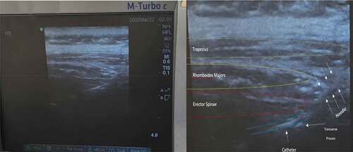 Figure 1. Ultrasonographic picture of catheter insertion for continuous ESPB