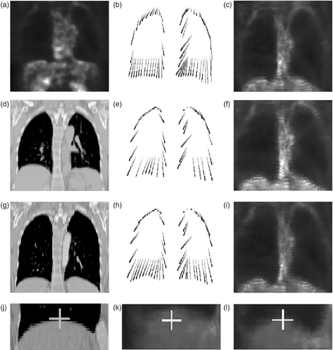 Figure 12. Original PET (a) and CT (d and g) images in a normal case (patient A). Correspondences between selected points in a PET image and an end-inspiration CT image (g) are shown in (b) for the direct method, in (e) for the method with the breathing model and a non-uniform landmark points detection, and in (h) for the method with the breathing model and a pseudo-uniform landmark points selection (corresponding points are linked). PET data is shown in (c) with the direct method, in (f) with the method using the breathing model with a non-uniform landmark points distribution, and in (i) with the method using the breathing model and landmark points pseudo-uniformly distributed. The fourth row of images shows registration details on the bottom part of the right lung in a normal case: (j) is the end-inspiration CT; (k) shows PET data registered without the breathing model; and (l) shows PET data registered with the breathing model. The white crosses correspond to the same coordinates. The method using the breathing model provides a better registration of the lung surfaces. [Color version available online.]