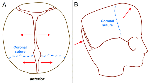 Figure 3. Bilateral coronal craniosynostosis. Top view (B) and lateral view (B) schematics showing the direction of compensatory calvarial growth (red lines) secondary to premature fusion of both coronal sutures (blue dashed lines) leading to shortening in the anteroposterior direction, increased height of the vault and therefore a turribrachycephalic deformity.