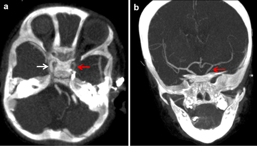 Figure 3 Axial (a) and coronal (b) maximum intensity projection images showing poor contrast material filling of the ipsilateral internal carotid artery (red arrow) relative to the contralateral side (white arrow).