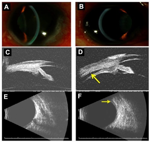 Figure 2 Slit-lamp photographs of the right (A) and left (B) eye demonstrating relative deepening of the anterior chambers after discontinuation of methazolamide. High-frequency (35 MHz) ultrasound biomicroscopy reveals resolution of ciliary body edema and supraciliary effusion in the right eye (C) and near complete resolution (arrow) in the left eye (D). Anterior chamber depth measured 2.7 mm and 2.3 mm in the right and left eye, respectively. Lens thickness measured 4.7 mm and 4.9 mm in the right and left eye, respectively. B-scan ultrasonography reveals complete resolution of the posterior choroidal effusion in the right eye (E) and a small persistent effusion (arrow) in the left eye (F).