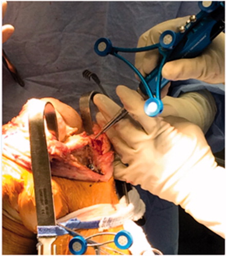 Figure 4. Use of optically-tracked bur to prepare the bone for placement of the cut-guide.