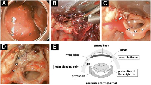 Figure 1. Endoscopic images before hemostasis (A) and during hemostasis (B-D), and schema of the surgical field (E). (A) Endoscopic observation revealed a huge coagulum extending from the tongue base to the hypopharynx. The larynx was not visible, and bleeding points were not identified. (B) After a blade (*) was placed over the tongue base, a huge blood coagulum was found and removed with forceps and suction. (C) Main bleeding point was identified on the left pharyngolaryngeal fold (arrow), and there was a perforation in the epiglottis (arrowhead), through which the arytenoids (*) were visible. (D) The area between the epiglottic vallecula and the tongue base was covered with necrotic tissue. The left side of the hyoid bone was exposed (arrowhead). (E) Schema of the surgical field. The spread of necrotic tissue is enclosed by a dotted line.